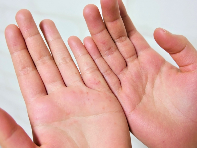 掌蹠膿疱症（しょうせきのうほうしょう）について